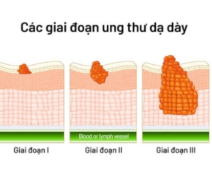 Làm gì khi ung thư dạ dày ở giai đoạn muộn